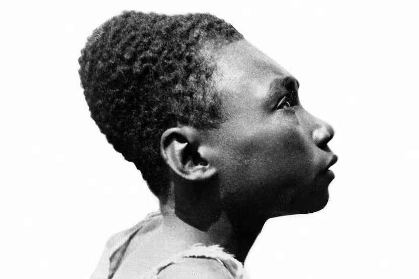 A young African girl Artificial cranial deformation.